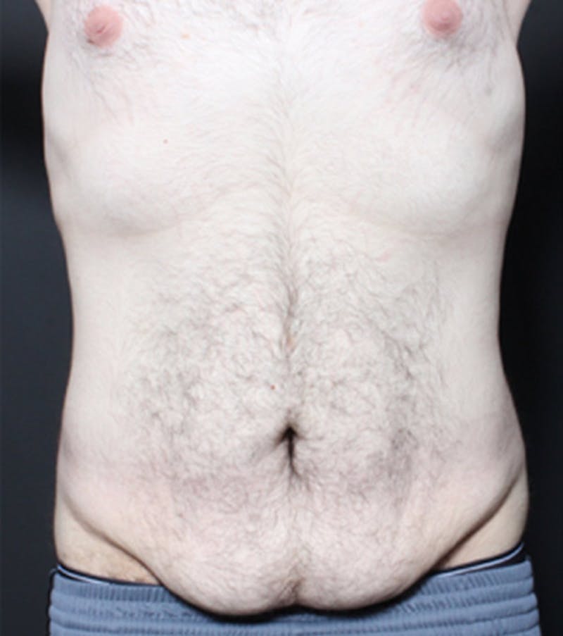 Male Tummy Tuck Before & After Gallery - Patient 722046 - Image 3
