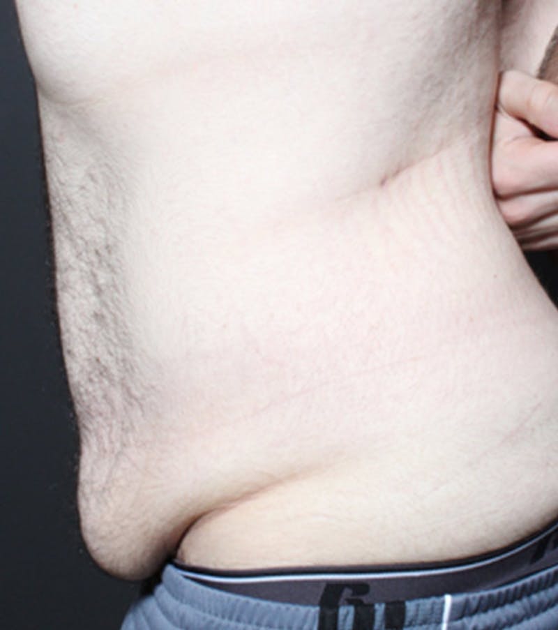 Male Tummy Tuck Before & After Gallery - Patient 722046 - Image 5