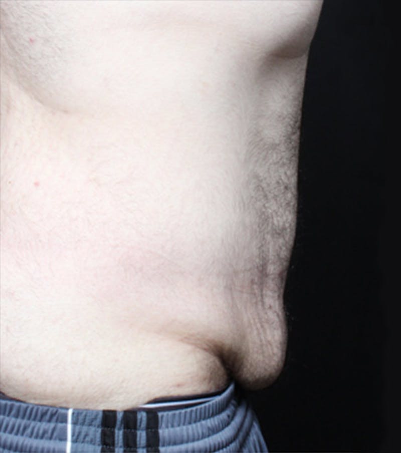 Male Tummy Tuck Before & After Gallery - Patient 722046 - Image 7