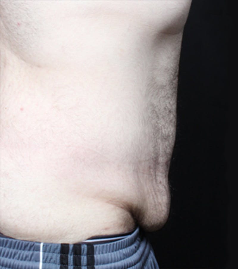Male Tummy Tuck Before & After Gallery - Patient 722046 - Image 7