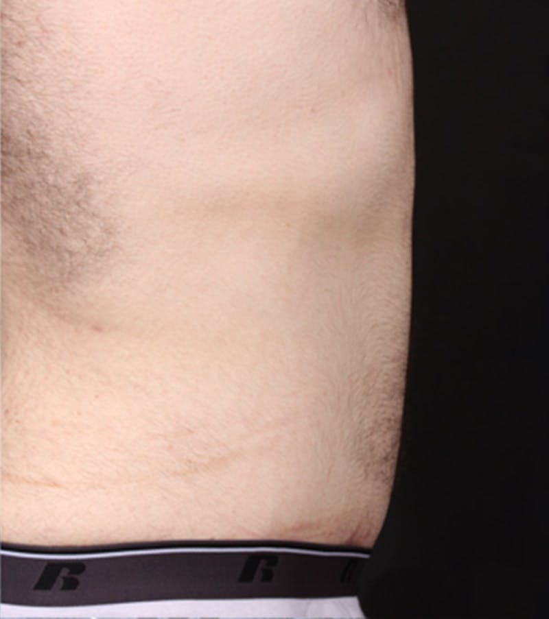Male Tummy Tuck Before & After Gallery - Patient 722046 - Image 8