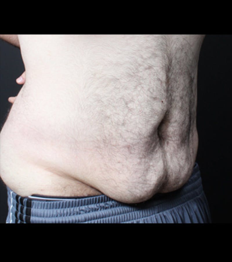 Male Tummy Tuck Before & After Gallery - Patient 722046 - Image 9