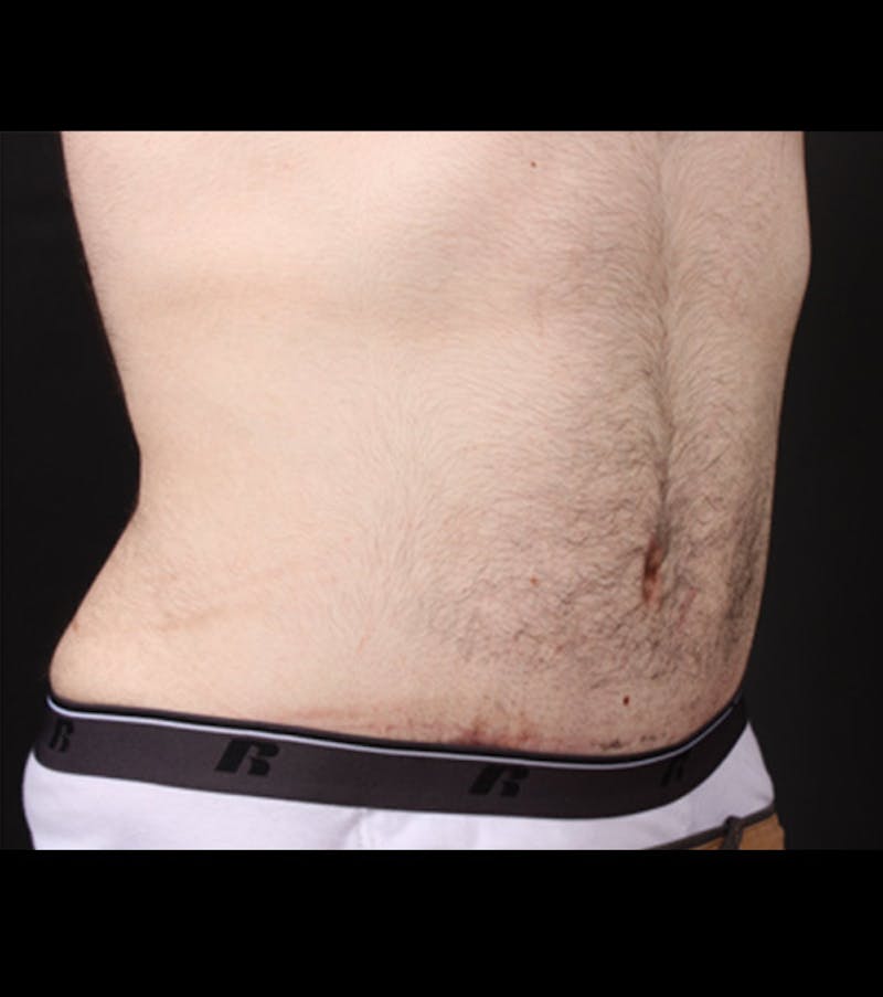 Male Tummy Tuck Before & After Gallery - Patient 722046 - Image 10