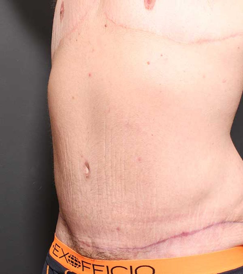 Male Tummy Tuck Before & After Gallery - Patient 320714 - Image 2