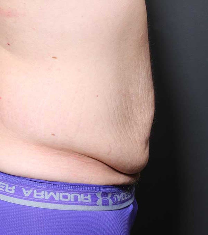 Male Tummy Tuck Before & After Gallery - Patient 320714 - Image 9