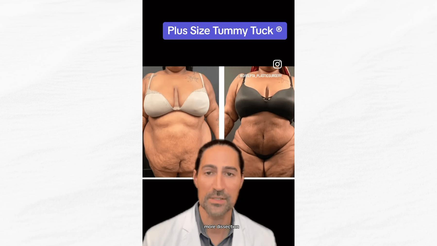Plus Size Tummy Tuck
