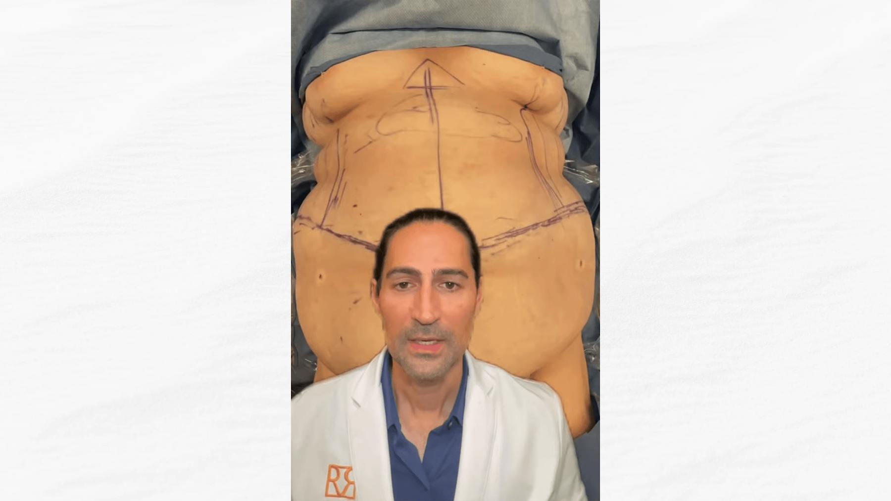 Plus Size Tummy Tuck