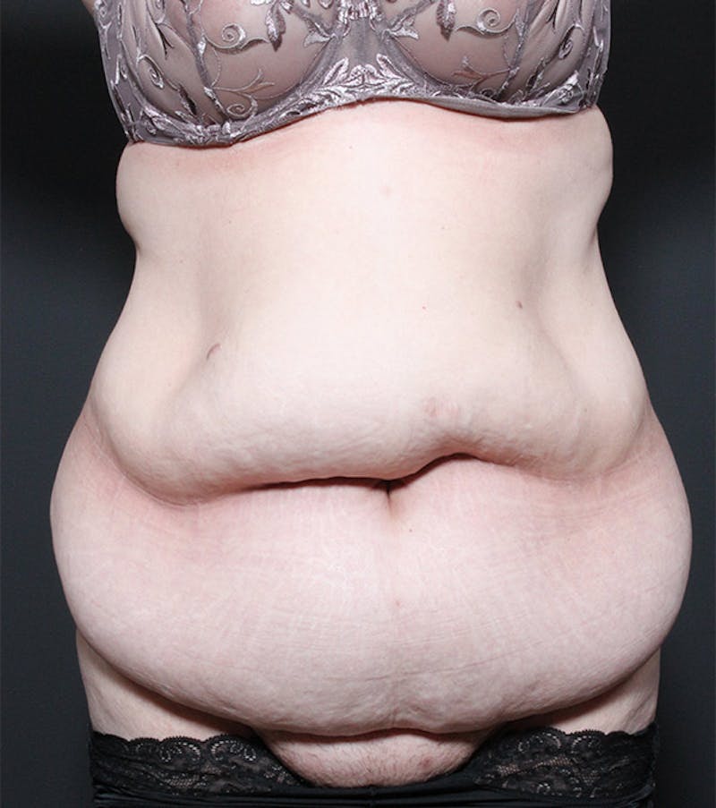 Liposuction Before & After Gallery - Patient 352238 - Image 3