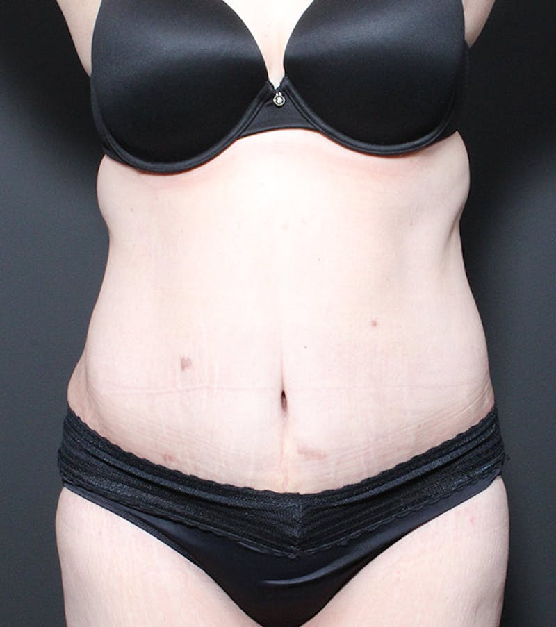 Liposuction Before & After Gallery - Patient 352238 - Image 4