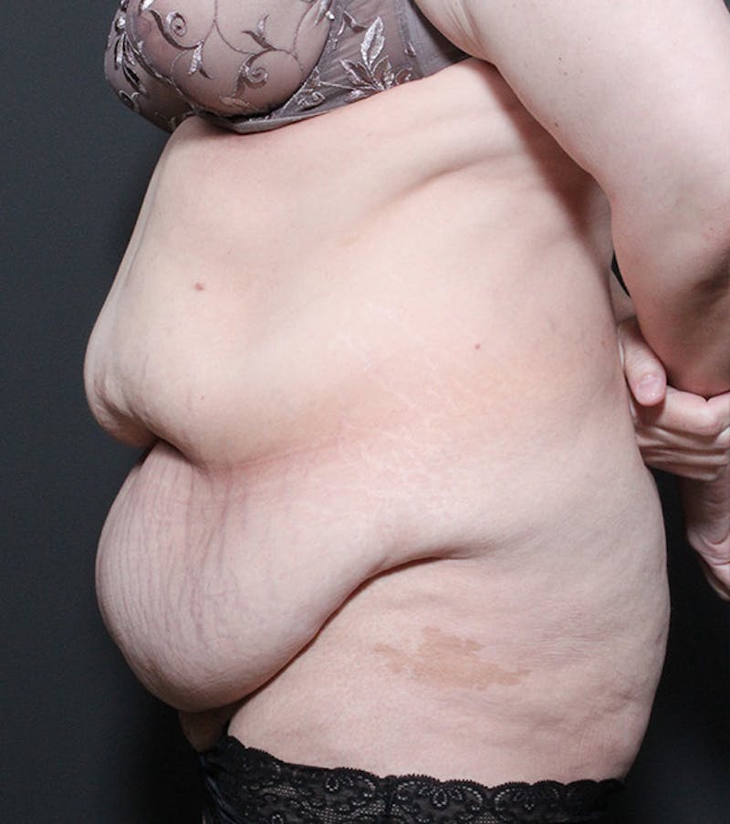 Liposuction Before & After Gallery - Patient 352238 - Image 5