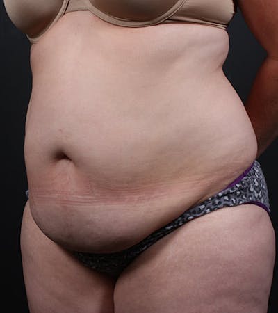 Liposuction Before & After Gallery - Patient 430630 - Image 1