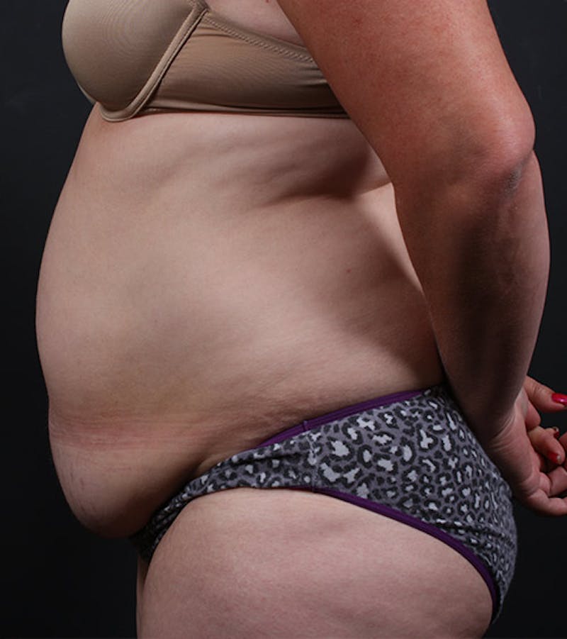 Liposuction Before & After Gallery - Patient 430630 - Image 5