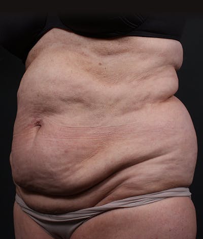 Liposuction Before & After Gallery - Patient 420613 - Image 1