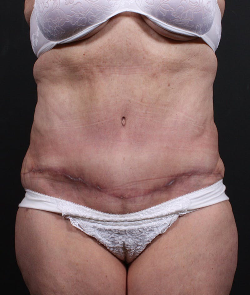 Liposuction Before & After Gallery - Patient 420613 - Image 4