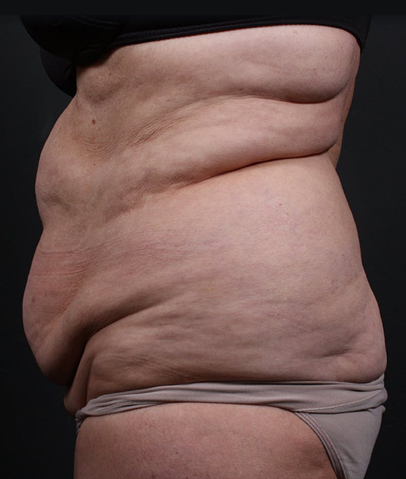 Liposuction Before & After Gallery - Patient 420613 - Image 5