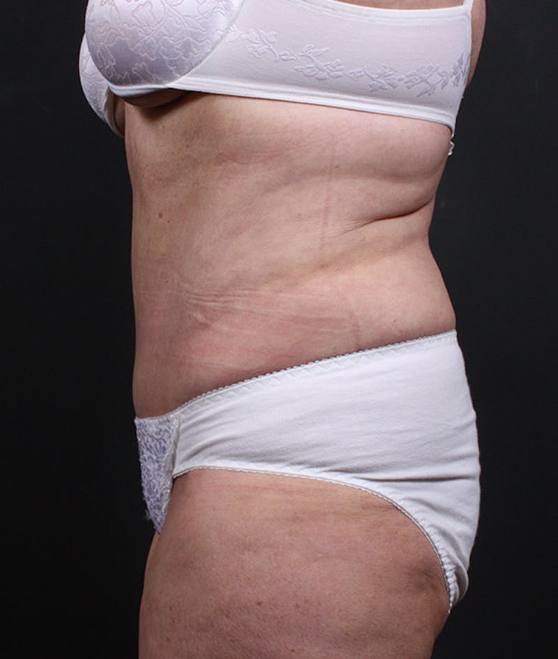 Liposuction Before & After Gallery - Patient 420613 - Image 6