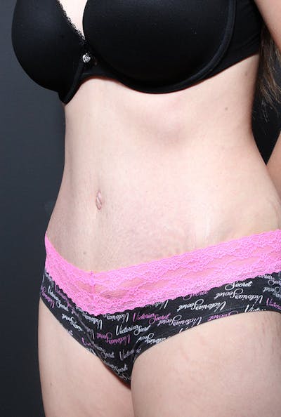 Liposuction Before & After Gallery - Patient 616409 - Image 2