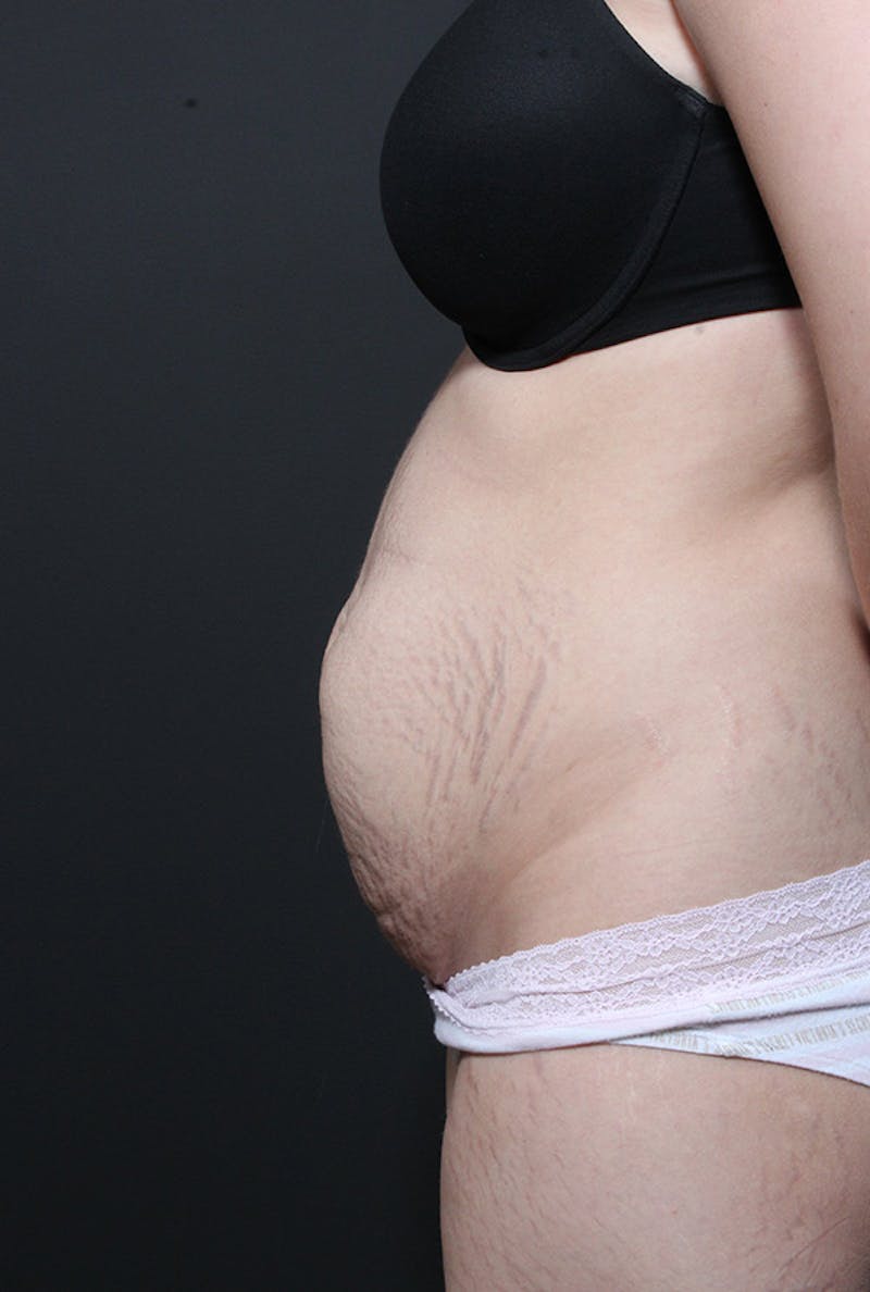 Liposuction Before & After Gallery - Patient 616409 - Image 5