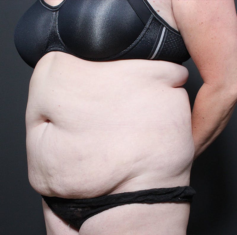Liposuction Before & After Gallery - Patient 259761 - Image 1