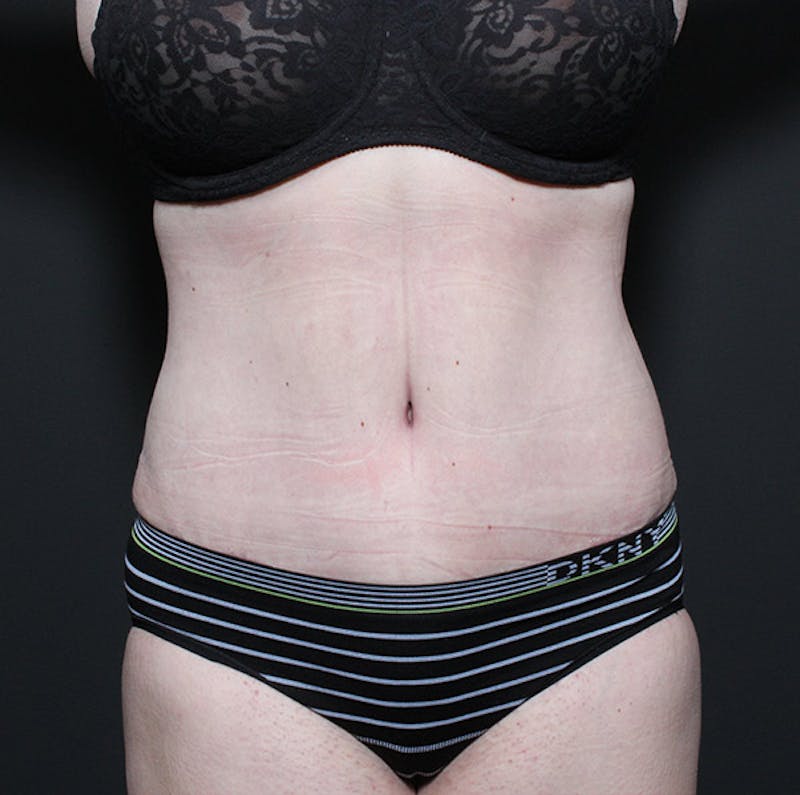 Liposuction Before & After Gallery - Patient 259761 - Image 4