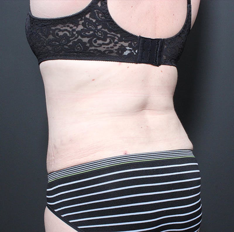 Liposuction Before & After Gallery - Patient 259761 - Image 8