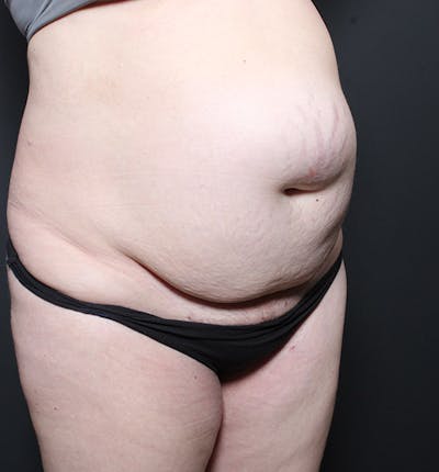 Hernia/Rectus Repair Before & After Gallery - Patient 409150 - Image 1