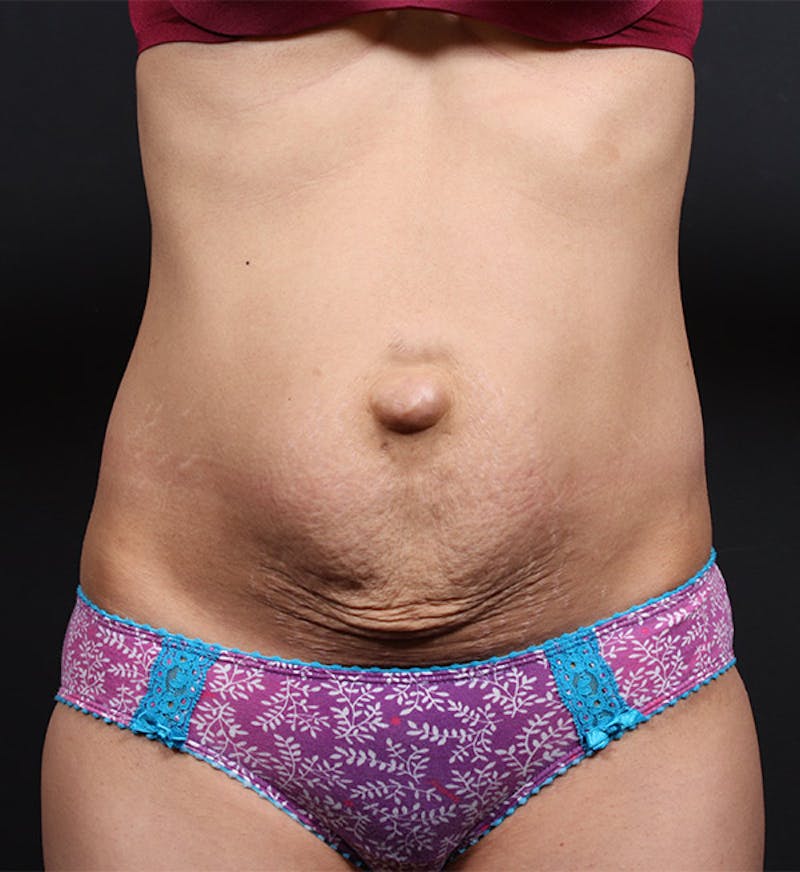 Liposuction Before & After Gallery - Patient 265041 - Image 3