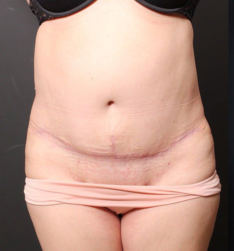 Hernia/Rectus Repair Before & After Gallery - Patient 409150 - Image 4