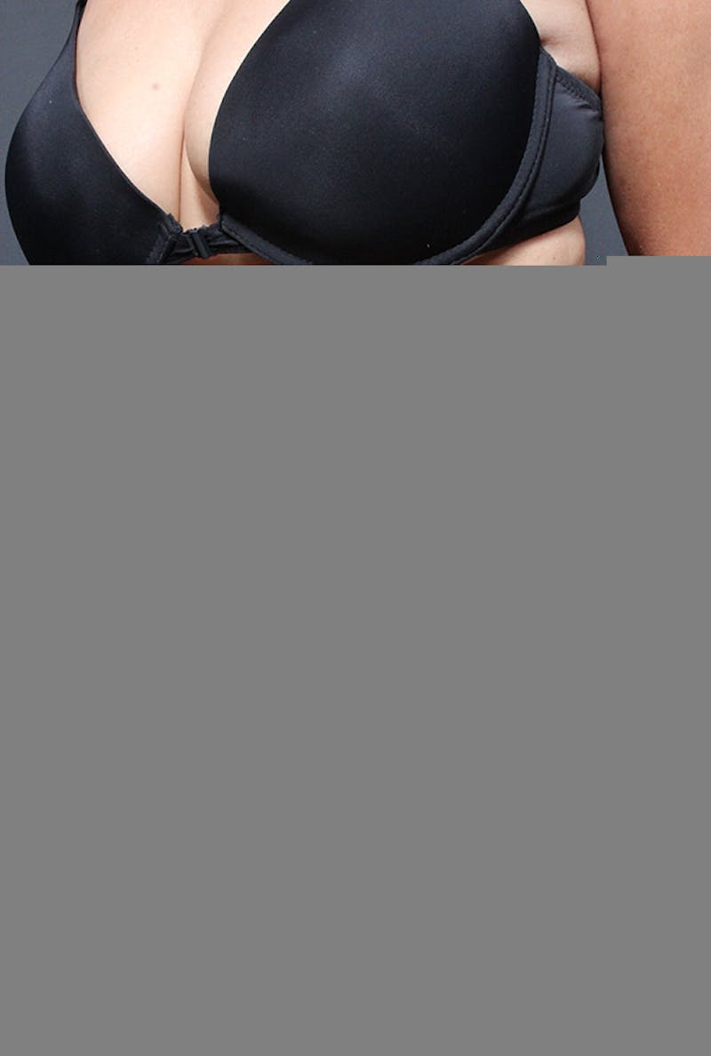 Liposuction Before & After Gallery - Patient 203500 - Image 1