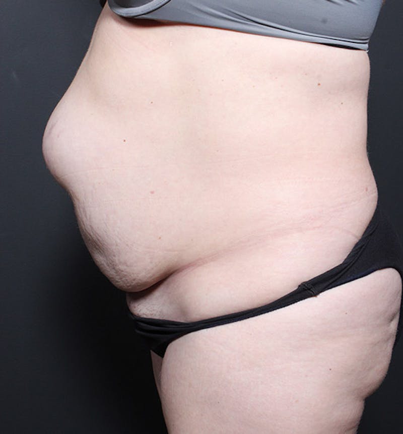 Hernia/Rectus Repair Before & After Gallery - Patient 409150 - Image 9