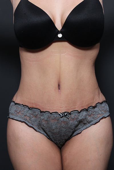 Liposuction Before & After Gallery - Patient 203500 - Image 2