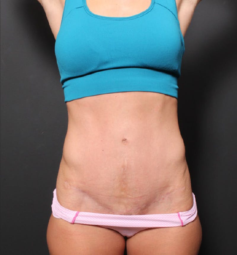 Hernia/Rectus Repair Before & After Gallery - Patient 288879 - Image 4