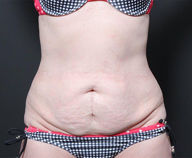 Liposuction Before & After Gallery - Patient 382637 - Image 3