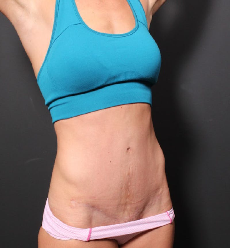 Hernia/Rectus Repair Before & After Gallery - Patient 288879 - Image 8