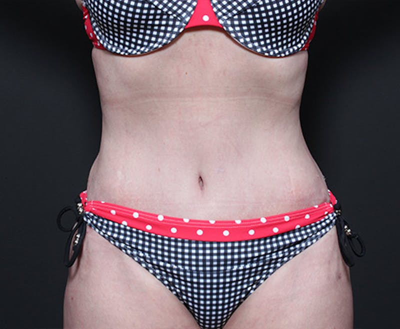 Liposuction Before & After Gallery - Patient 382637 - Image 4