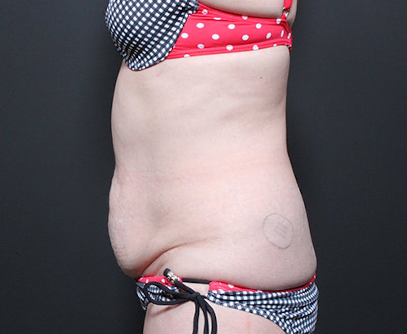 Liposuction Before & After Gallery - Patient 382637 - Image 5