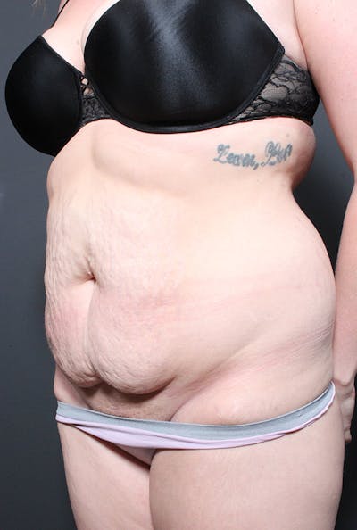 Liposuction Before & After Gallery - Patient 300687 - Image 1