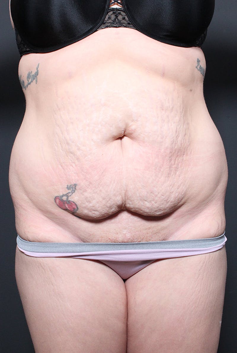 Liposuction Before & After Gallery - Patient 300687 - Image 3
