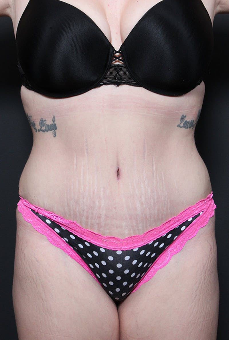 Liposuction Before & After Gallery - Patient 300687 - Image 4