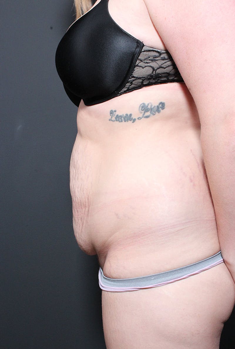 Liposuction Before & After Gallery - Patient 300687 - Image 5
