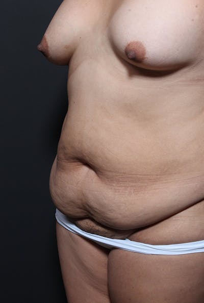 Liposuction Before & After Gallery - Patient 439609 - Image 1