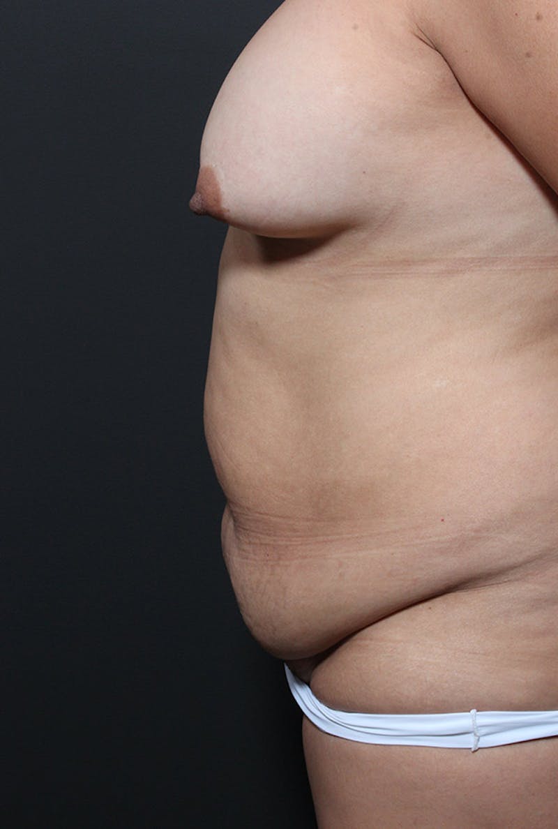 Liposuction Before & After Gallery - Patient 439609 - Image 5