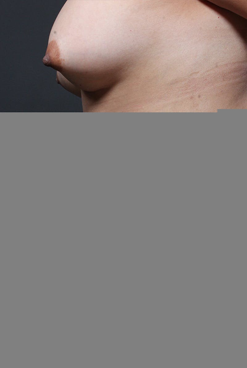 Liposuction Before & After Gallery - Patient 439609 - Image 6