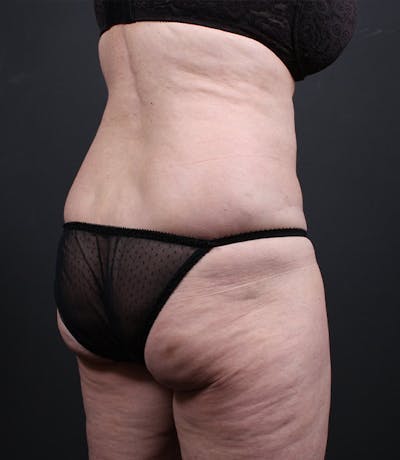 Liposuction Before & After Gallery - Patient 283503 - Image 1