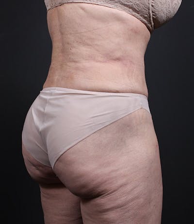 Liposuction Before & After Gallery - Patient 283503 - Image 2