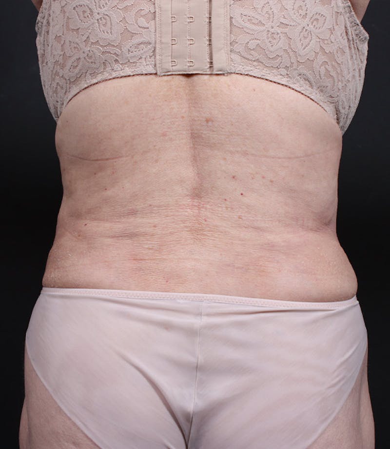 Liposuction Before & After Gallery - Patient 283503 - Image 4