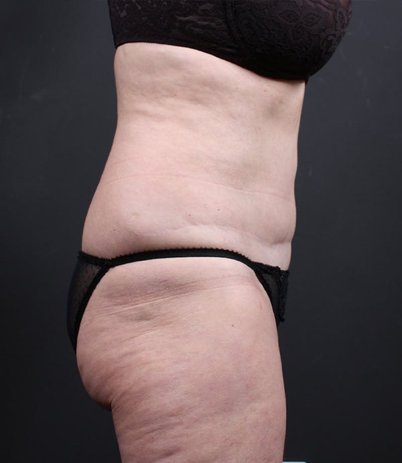 Liposuction Before & After Gallery - Patient 283503 - Image 5