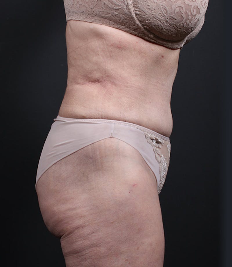 Liposuction Before & After Gallery - Patient 283503 - Image 6