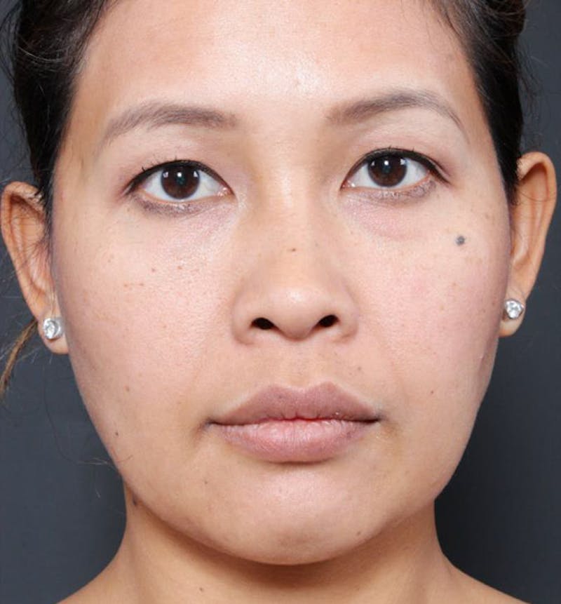 Genioplasty Before & After Gallery - Patient 225563 - Image 3
