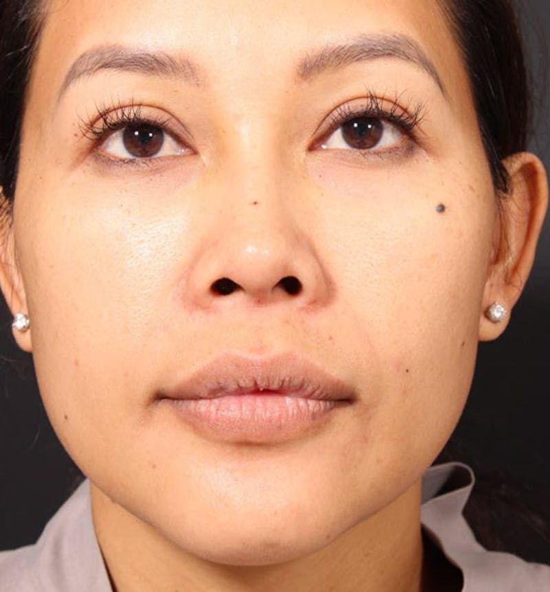 Genioplasty Before & After Gallery - Patient 225563 - Image 4